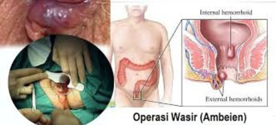 Cara Mengatasi Penyakit Ambeien