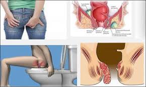 Cara Mengatasi Ambeien Dengan Cepat