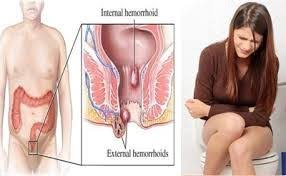 Cara Mengatasi Ambeien Sehabis Melahirkan